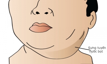 Nhiều thanh thiếu niên ở phía Nam mắc bệnh quai bị