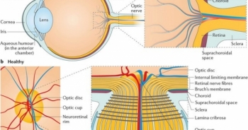 Xác định được 40 chuỗi ADN gây bệnh glaucoma dẫn tới mù lòa