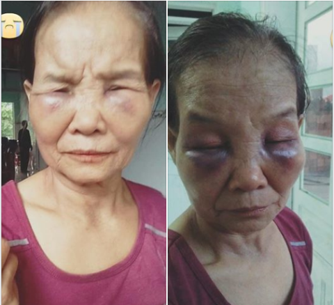 H&igrave;nh ảnh được cho l&agrave; b&agrave; T. bị con d&acirc;u đ&aacute;nh th&acirc;m t&iacute;m 2 mắt. Ảnh: FB