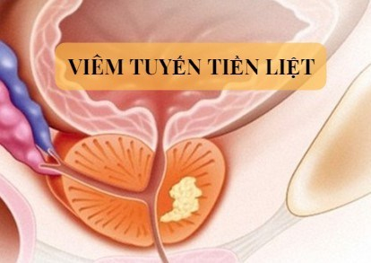 viem-tuyen-tien-liet