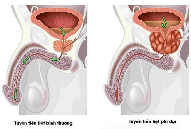 benh-u-xo-tuyen-tien-liet