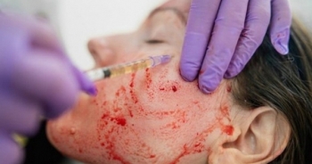 Bác sĩ Bệnh viện Da liễu Trung ương: "Không nên thần thánh hoá phương pháp làm đẹp bằng máu"