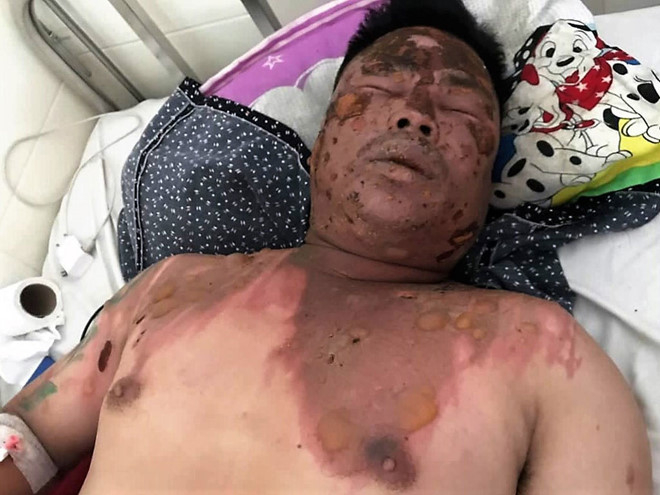 Anh Giản bị bỏng nặng ở đầu, mặt, cổ và ngực