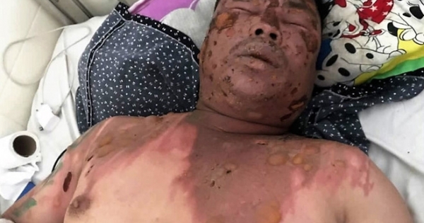 Đang ngồi nhậu ở đám cưới bạn thân, nam thanh niên bị hất cả nồi lẩu đang sôi vào mặt