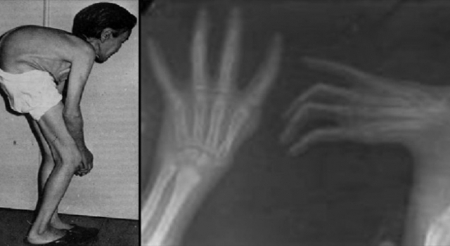 Căn bệnh kinh hoàng được đặt tên theo tiếng kêu khóc người trúng độc