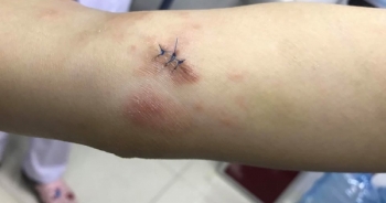 Tưởng viêm da cơ địa không ngờ mắc ung thư tế bào lympho T