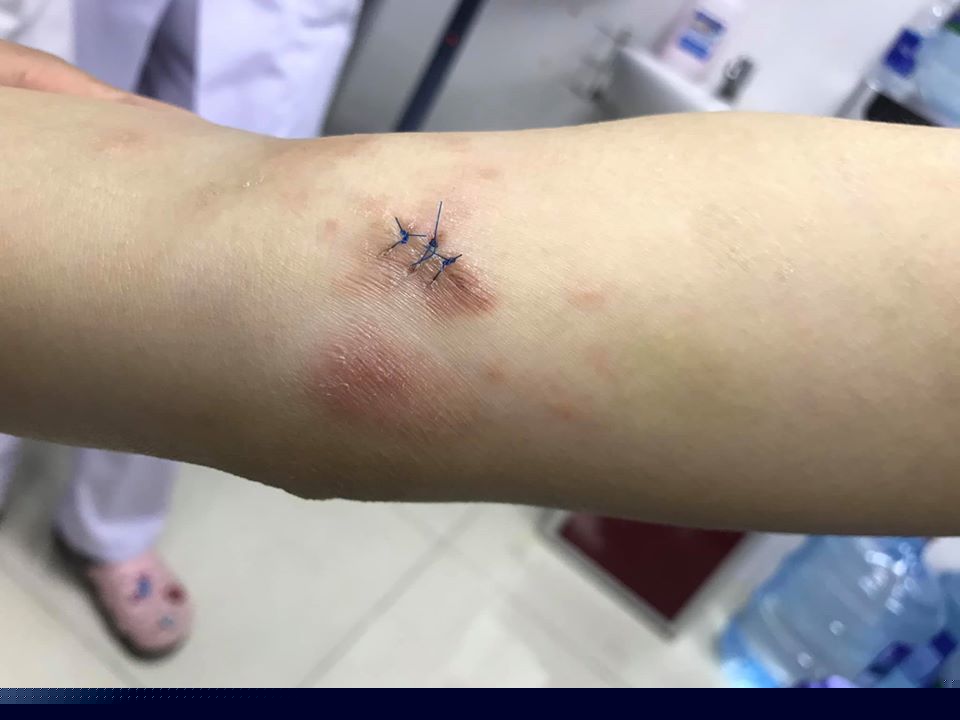 Tưởng viêm da cơ địa, hóa ung thư da xâm lấn