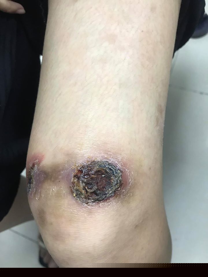 Tưởng viêm da cơ địa, hóa ung thư da xâm lấn