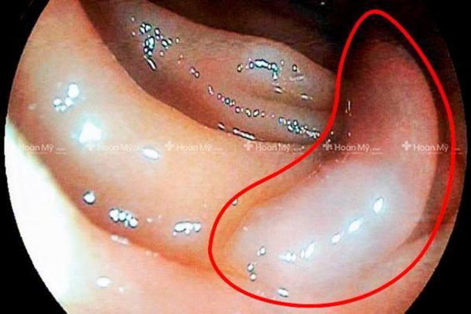 Hình ảnh siêu âm cho thấy con sán xuất hiện ở tá tràng