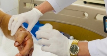 Phẫu thuật nối thành công bàn tay bệnh nhân bị đứt lìa