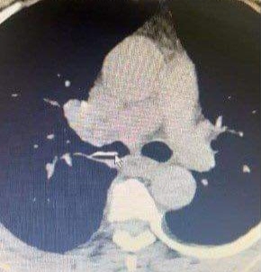 Phát hiện mảnh xương lợn bị mắc trong phế quản của người bệnh suốt 1 năm