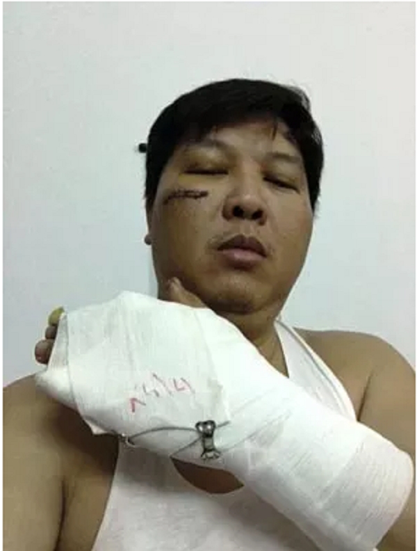 &Ocirc;ng Đinh Hữu Hướng cho rằng bị &ocirc;ng V&otilde; Hữu Th&agrave;nh đ&aacute;nh, g&acirc;y nhiều thương t&iacute;ch.