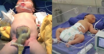 Quảng Ninh: 3 giờ nghẹt thở cứu bé sơ sinh bị lòi toàn bộ ruột, tạng ra ngoài