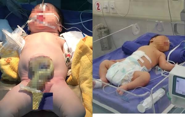 B&eacute; V&acirc;n đ&atilde; được phẫu thuật th&agrave;nh c&ocirc;ng tho&aacute;t vị rốn. Ảnh: VietNamNet