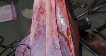 Nghệ An: Cắt bỏ thành công khối u nặng 6 kg ra khỏi ổ bụng của cụ bà 102 tuổi