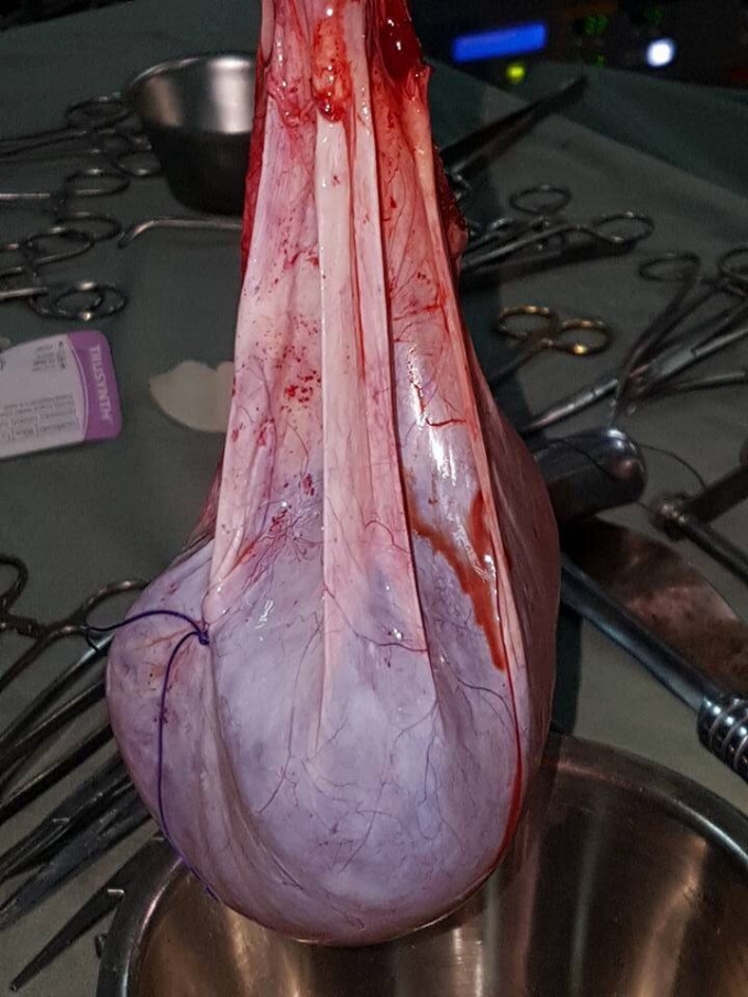 Khối u c&oacute; trọng lượng l&ecirc;n đến 6 kg được c&aacute;c b&aacute;c sĩ cắt bỏ ra khỏi ổ bụng của cụ b&agrave; 102 tuối.