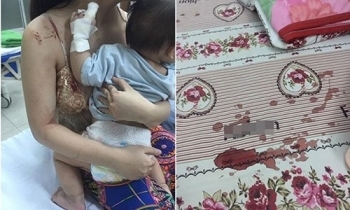 Sốc: Bé gái bị chuột cắn nát tay khi đang ngủ