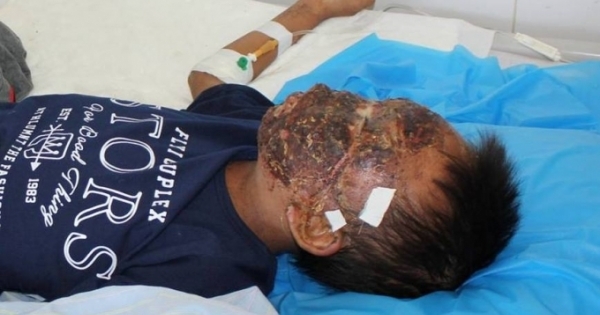 Ngã vào bếp lửa đang cháy, khuôn mặt bé trai 14 tuổi bị "nướng chín"