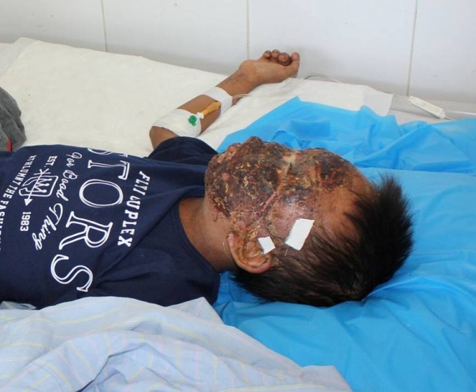 Ng&atilde; v&agrave;o bếp lửa đang ch&aacute;y khu&ocirc;n mặt của b&eacute; trai bị bỏng gần như ho&agrave;n to&agrave;n, một mắt của em cũng đ&atilde; hỏng, mắt c&ograve;n lại cũng bị bỏng rất nặng.