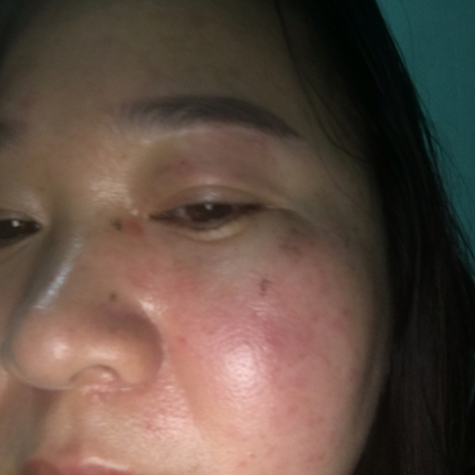 Khu&ocirc;n mặt sưng tấy của chị Nhung sau khi bị &ocirc;ng Vũ h&agrave;nh hung.