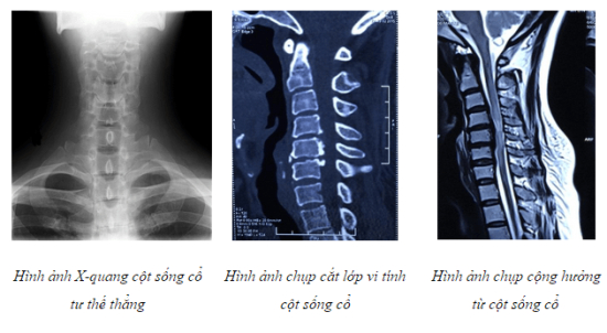 H&igrave;nh ảnh tổn thương cột sống cổ g&acirc;y liệt kh&ocirc;ng ho&agrave;n to&agrave;n. Ảnh: TQK