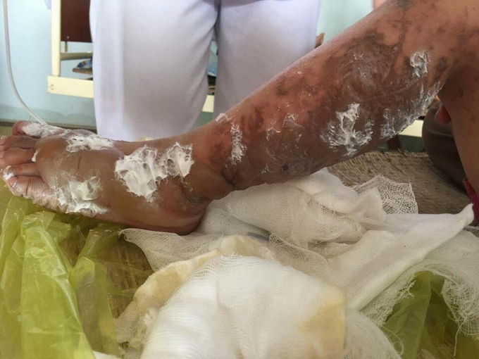 H&igrave;nh ảnh đau l&ograve;ng khi những vết bỏng hằn r&otilde; tr&ecirc;n ch&acirc;n c&aacute;c ch&aacute;u.