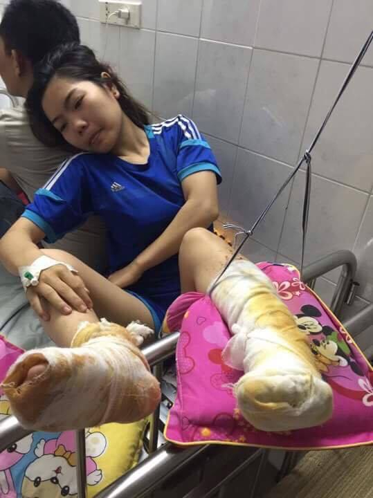 Nạn nh&acirc;n Trần Thị Mai Hi&ecirc;n (c&ocirc; ruột của hai ch&aacute;u) bị bỏng nặng 2 ch&acirc;n sau khi ng&atilde; v&agrave;o đống r&aacute;c đang &acirc;m ỉ ch&aacute;y.