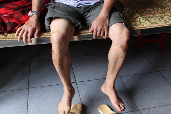 &Ocirc;ng Thanh chỉ những vết thương tr&ecirc;n người khi bị lũ cuốn...