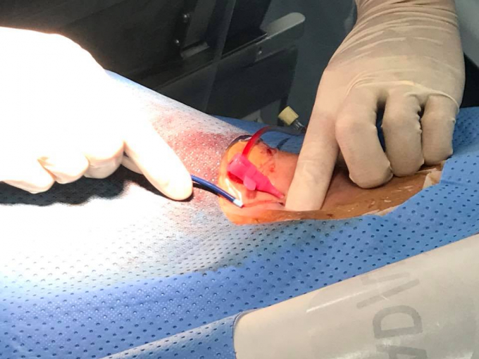 H&igrave;nh ảnh trong ca phẫu thuật cho 4 b&eacute;. (Ảnh: BVCC)