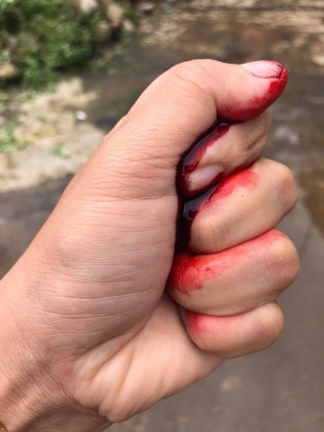 Nh&igrave;n bức ảnh n&agrave;y ai cũng ngỡ b&agrave;n tay đang đầm đ&igrave;a m&aacute;u.