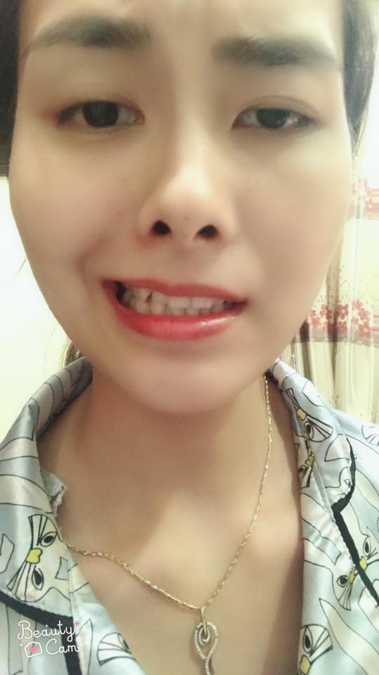 C&ocirc; g&aacute;i bị liệt lu&ocirc;n d&acirc;y thần kinh số 7 g&acirc;y ra m&eacute;o miệng.