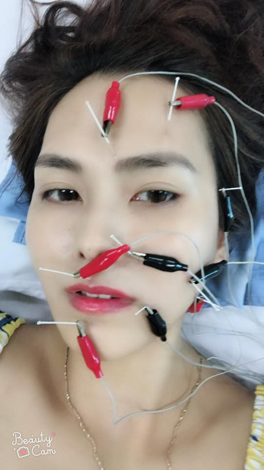 C&ocirc; phải thường xuy&ecirc;n đi ch&acirc;m cứu, bấm huyệt v&agrave; ti&ecirc;m.