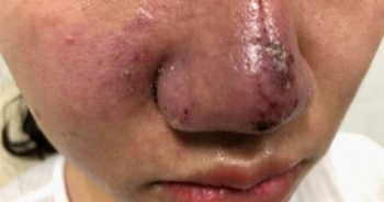 Thêm một ca méo mặt, bọc mủ vì tiêm filler làm đẹp