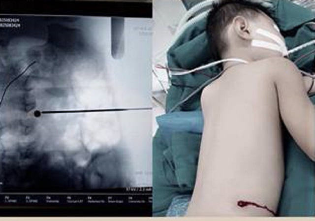 Vi&ecirc;n đạn đi v&agrave;o đường h&ocirc;ng - lưng găm v&agrave;o ngay cột sống. Ảnh: BVCC