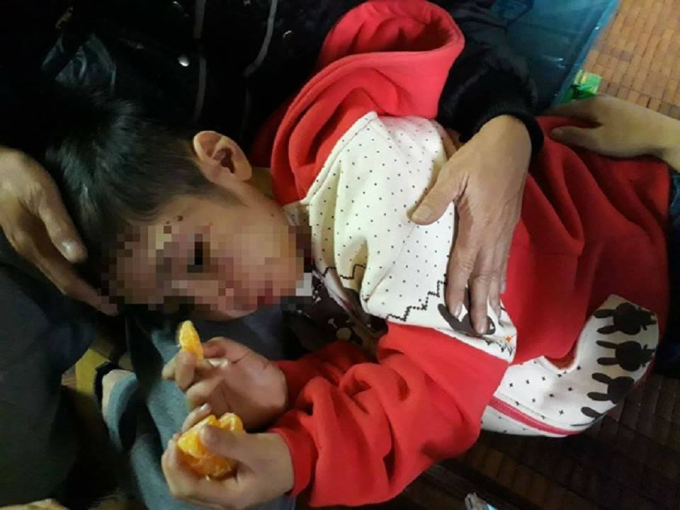 Ch&aacute;u K sau khị bị ph&aacute;t hiện do cha đẻ c&ugrave;ng mẹ kế bạo h&agrave;nh được mẹ v&agrave; &ocirc;ng b&agrave; nội chăm s&oacute;c.