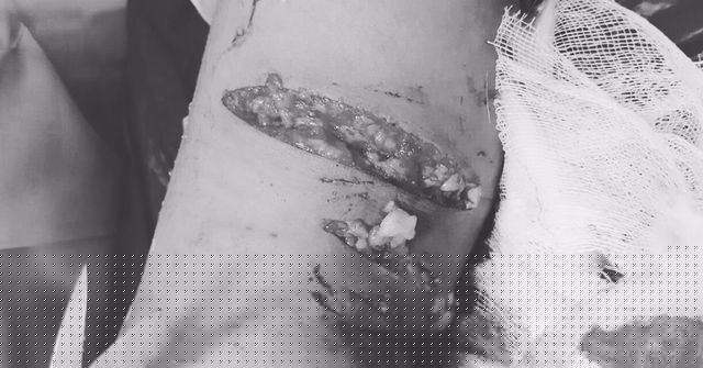 Chân bệnh nhi chằng chịt vết thương do chó cắn.