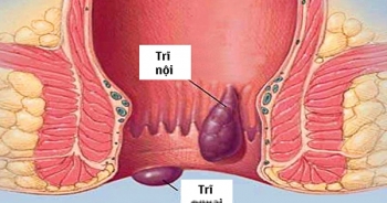 Điều trị thiếu máu do bệnh trĩ bằng y học cổ truyền