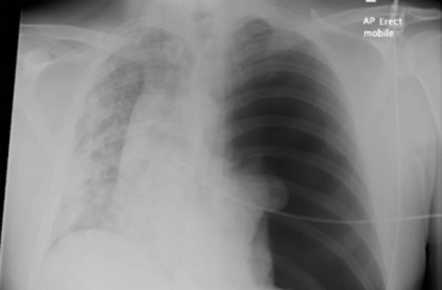 Hình ảnh phổi bị tàn phá của bệnh nhân Covid-19 36 tuổi