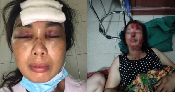 Người phụ nữ 44 tuổi tại Hải Dương tố cáo bị chồng chích điện, dìm xuống nước phải nhập viện cấp cứu