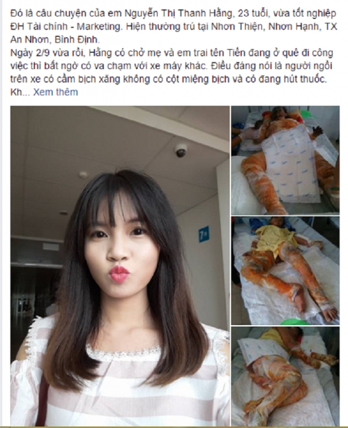 T&acirc;n cử nh&acirc;n Đại học T&agrave;i Ch&iacute;nh bị xăng đốt ch&aacute;y v&agrave; bỏng nặng. (Nguồn: Facebook).