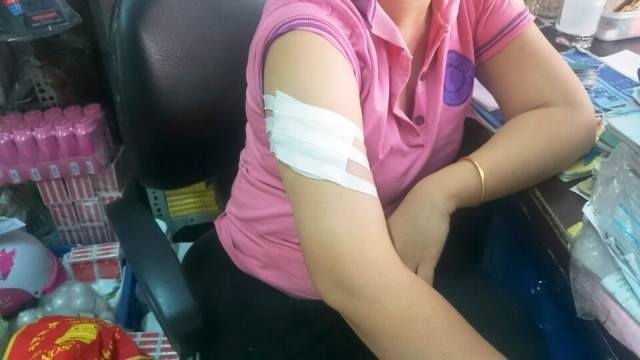 Vết thương ở tay chị H do bị ch&eacute;m