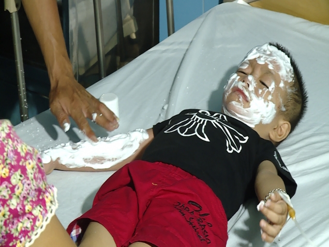 Một trong những nạn nh&acirc;n đang điều trị tại Bệnh viện Cu ba - Đồng Hới.