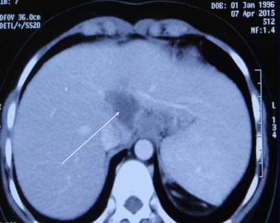 Khối lao gan được ph&aacute;t hiện tr&ecirc;n nữ sinh bị mắc Wilson. Ảnh:&nbsp;B&aacute;c sĩ cung cấp.