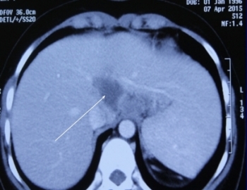 Chữa khỏi bệnh lao gan hiếm gặp trên thế giới cho nữ sinh