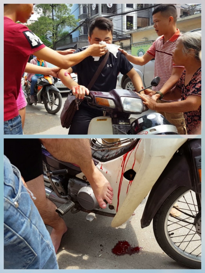 Anh Nguyễn Kh&aacute;nh (1996, tr&uacute; tại Ngọc Kh&aacute;nh, Ba Đ&igrave;nh, HN) bị vỡ khoang mũi do va phải thanh sắt. Ảnh: Huy Trung.