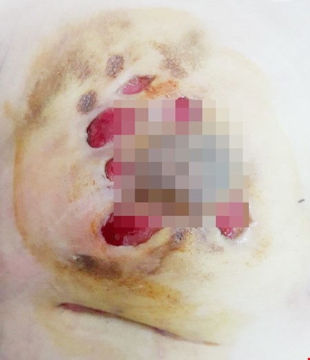 To&agrave;n bộ ngực phải của một bệnh nh&acirc;n bị hoại tử do bơm silicon. Ảnh: news.zing.vn