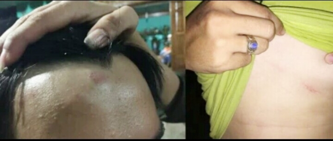 Những vết bầm t&iacute;m tr&ecirc;n người anh Việt. (ẢNh: QT).