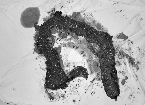 H&agrave;ng ngh&igrave;n khối u lớn nhỏ được lấy ra khỏi ruột gi&agrave; bệnh nh&acirc;n.&nbsp;Ảnh bệnh viện cung cấp.