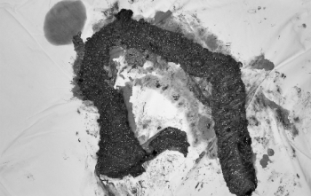 Hàng trăm khối u chi chít trong ruột già bệnh nhân