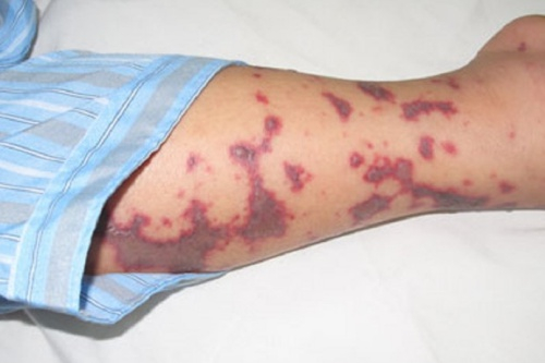 Khi mắc vi&ecirc;m n&atilde;o m&ocirc; cầu, bệnh nh&acirc;n sẽ c&oacute; chấm xuất huyết hoại tử h&igrave;nh sao rất đặc trưng. Ảnh:&nbsp;B&aacute;c sĩ cung cấp.&nbsp;